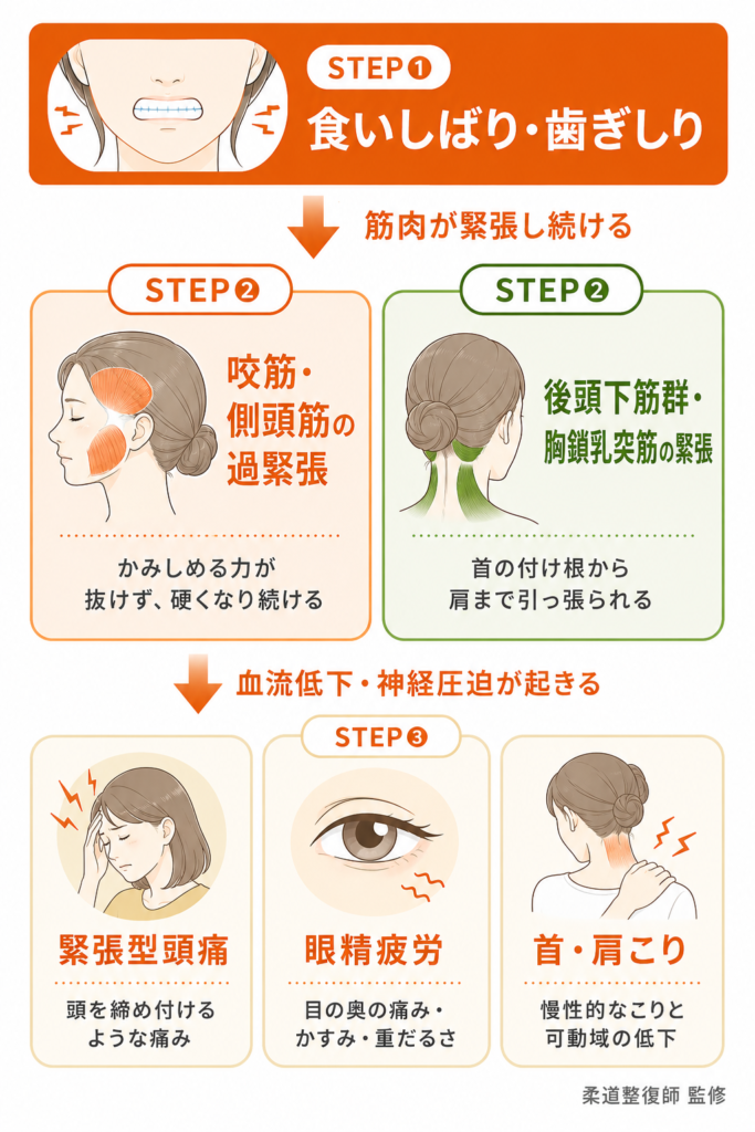 食いしばりが引き起こす症状の連鎖を示した図解。咬筋・側頭筋の過緊張から後頭下筋群・胸鎖乳突筋へと緊張が波及し、緊張型頭痛・眼精疲労・首肩こりを引き起こすメカニズムを柔道整復師が解説している。
