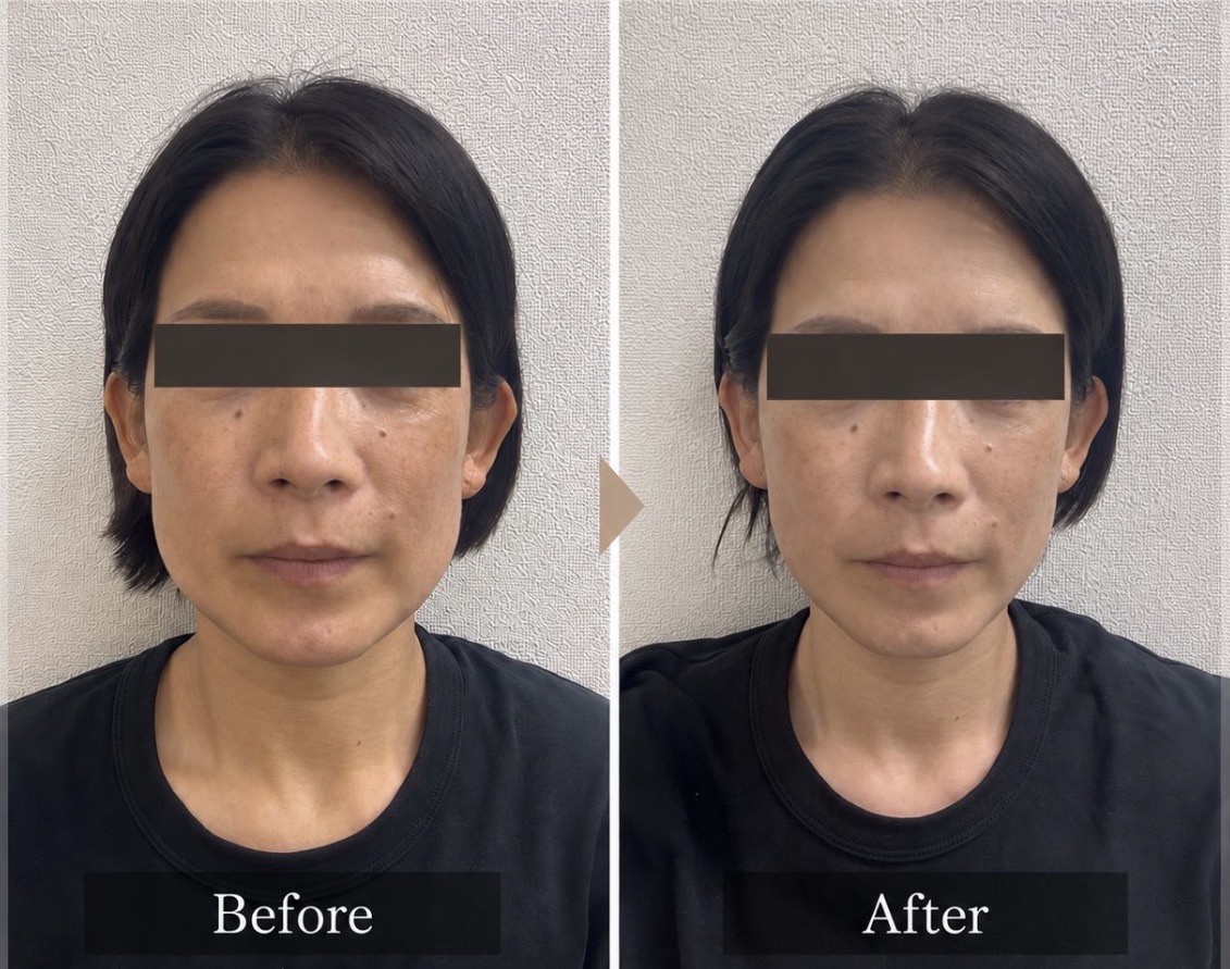 咬筋への施術前後の変化例。フェイスラインの張りが軽減した個人の一例（効果を保証するものではありません）」